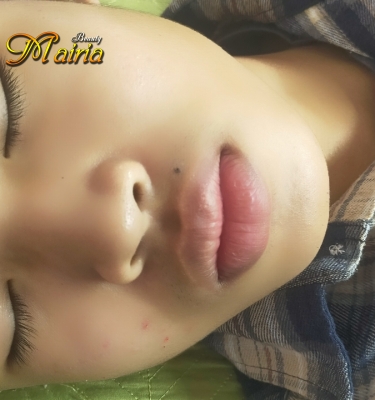 Xoá nốt ruồi 