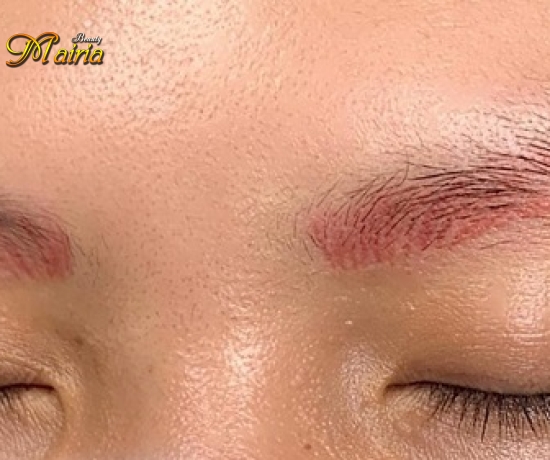 Quy trình thực hiện xoá sửa mày trổ xanh trổ đỏ 