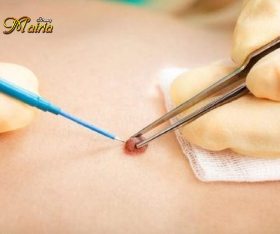 Xoá nốt ruồi 