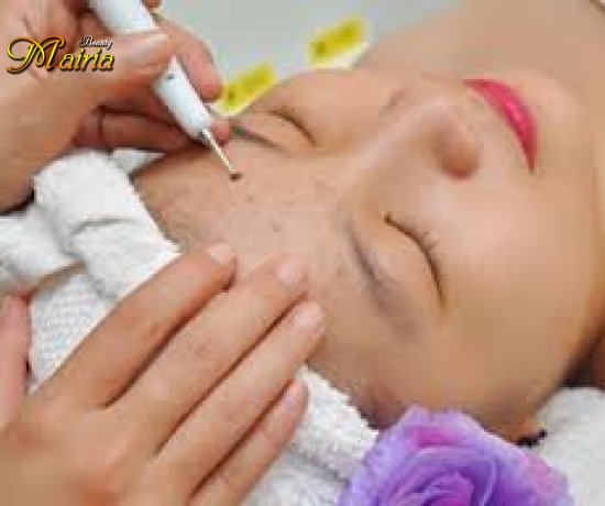 Xoá nốt ruồi 
