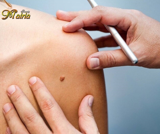 Xoá nốt ruồi 